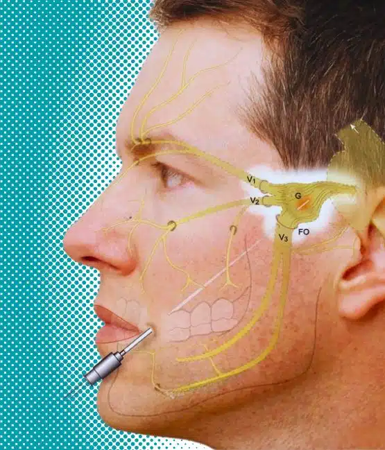 Neuralgia do Trigemeo