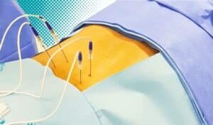 BLOG 35 Radiofrequencia para dor cronica