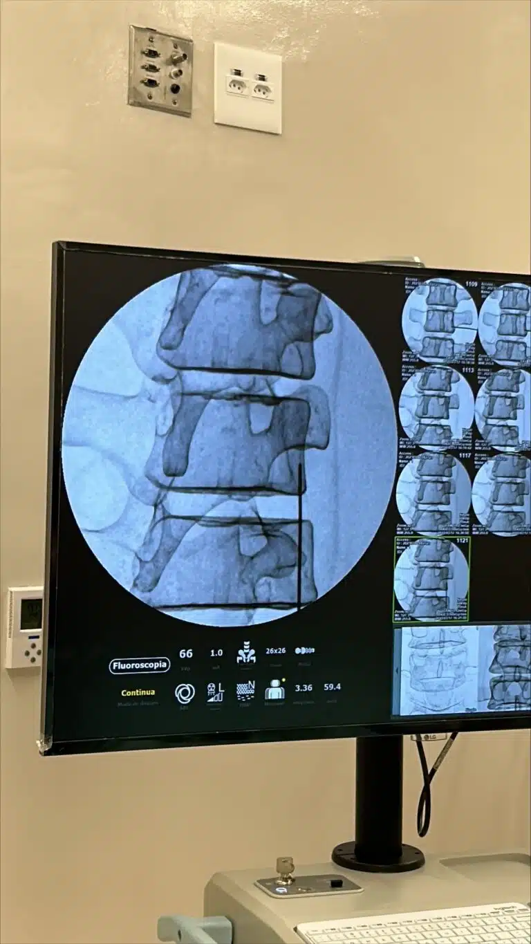radiofrequencia-para-dor-cronica