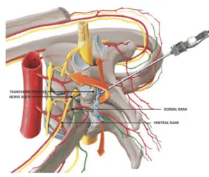 Neuralgia Pós Herpes Zoster 4 ultrasound for interventional pain management 2.png - março 2026