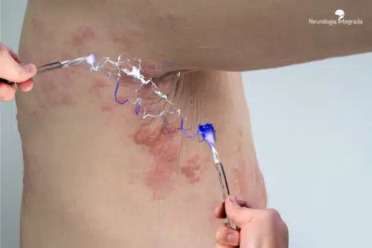 Entendendo a Dor do Herpes Zoster: Perguntas e Respostas 2 herpes zoster