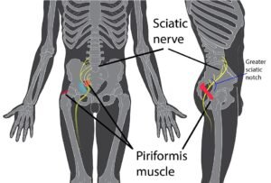 Ilustração anatômica mostrando o músculo piriforme e o nervo ciático na síndrome do piriforme