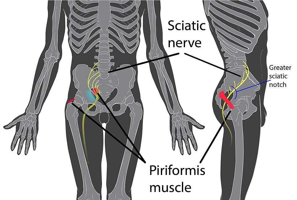 Localização da síndrome do piriforme: músculo piriforme comprimindo o nervo ciático